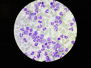 Chronic myeloid leukemia// Wikipedia