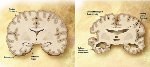 alzheimers_disease_brain_comparison