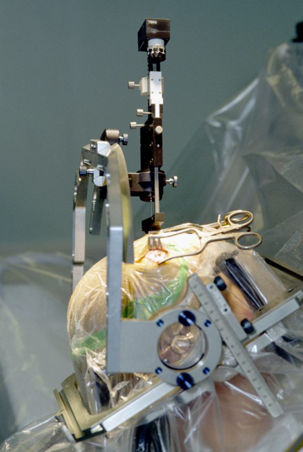 Insertion of electrode during surgery using a stereotactic frame / wikipedia.org