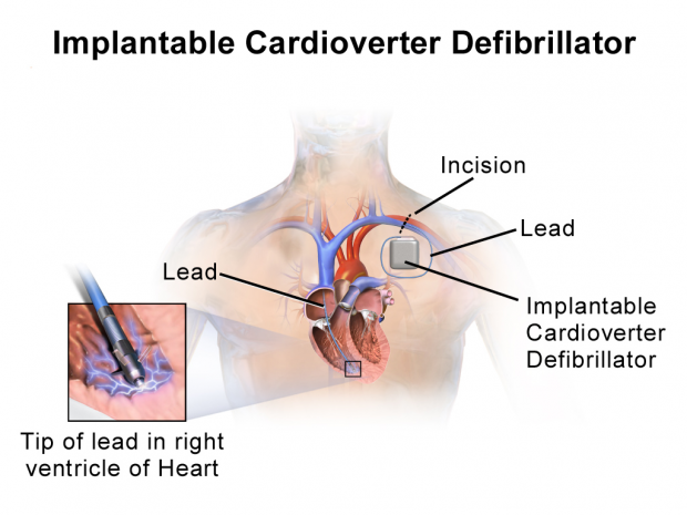 Illustration of Implantable Cardioverter Defibrillator (ICD) / wikipedia.org